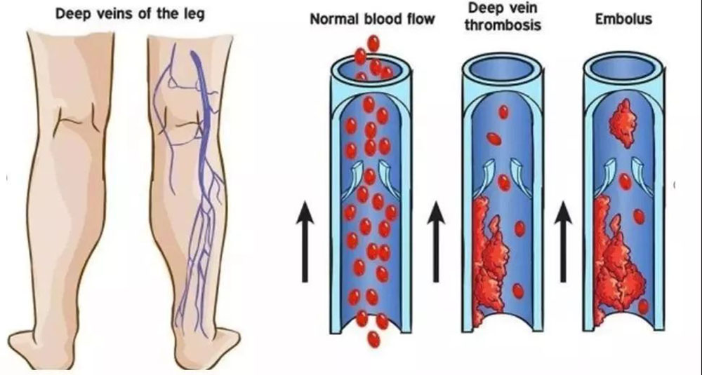 Deep vein thrombosis prevention