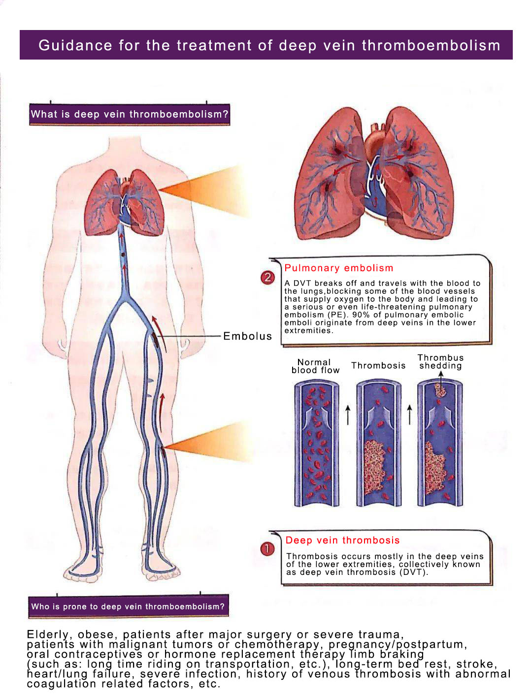 Prevention of DVT